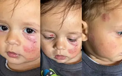 Bebê com rosto cheio de hematomas após ser mordido em creche