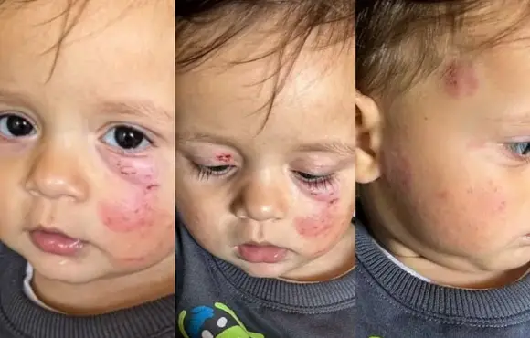 Bebê com rosto cheio de hematomas após ser mordido em creche